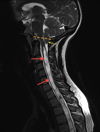 Chiari I malformation with syrinx