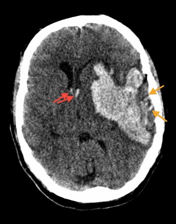 Hypertensive intracerebral haemorrhage