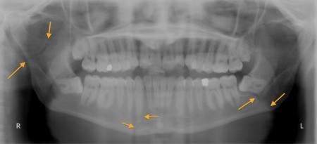 Mandibular fractures – OPG