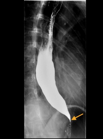 Achalasia – barium swallow