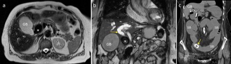 Gallstone Ileus