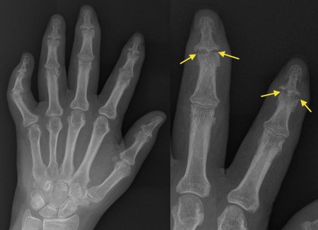 Psoriatic arthritis – DIP erosions