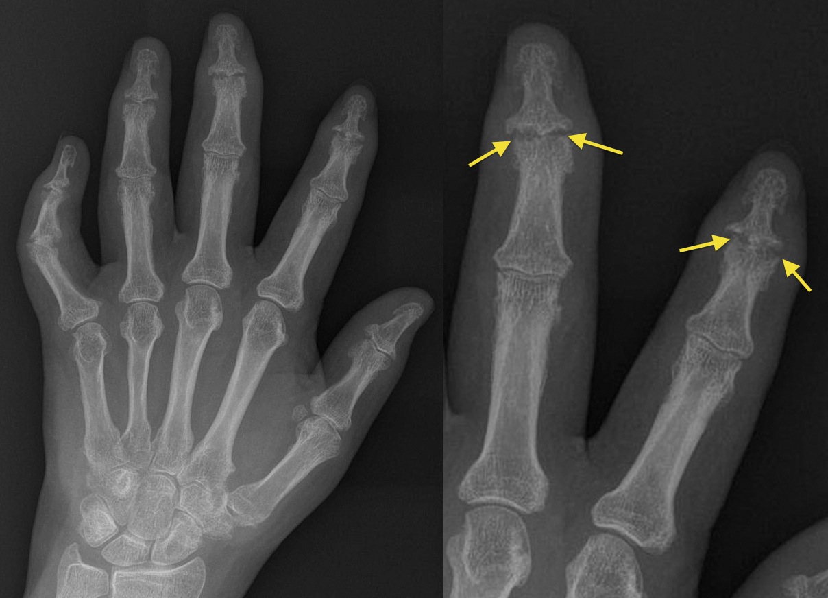 Psoriatic arthritis - DIP erosions - Radiology at St. Vincent's