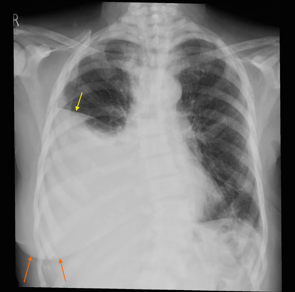 metastatic cancer pleural effusion paraziți în stomac decât să fie tratat