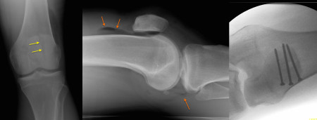 Compound patellar fracture