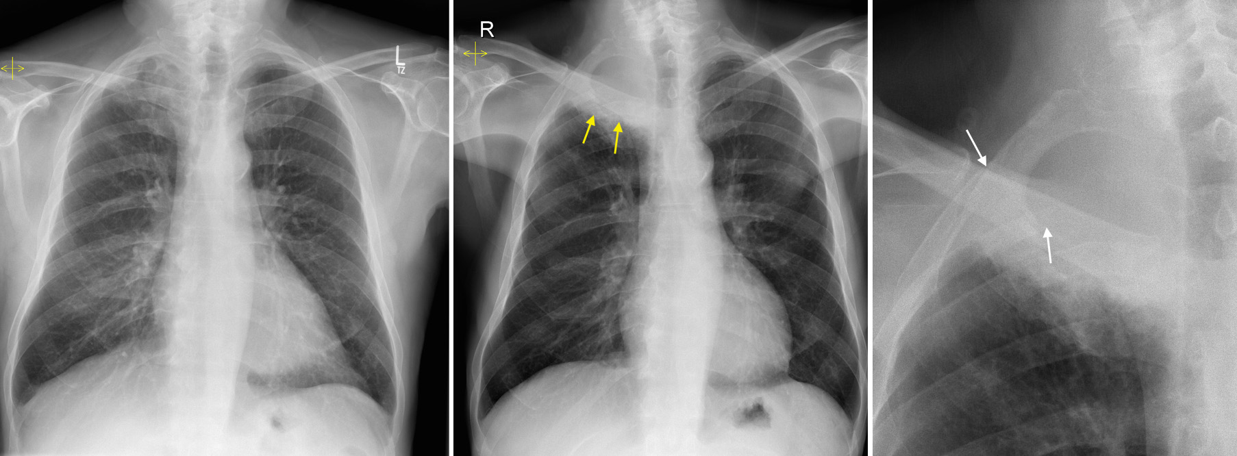 Pancoast tumour - Radiology at St. Vincent's University Hospital