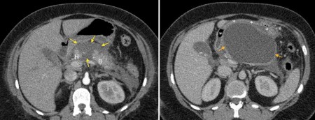 Pancreatic pseudocyst