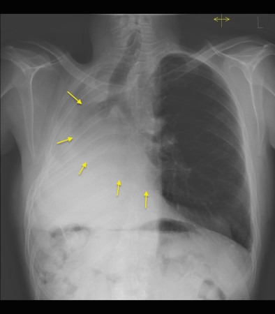 Pneumonectomy with compensatory hyperinflation