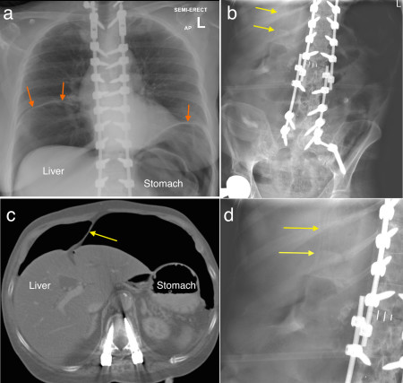 Falciform ligament sign