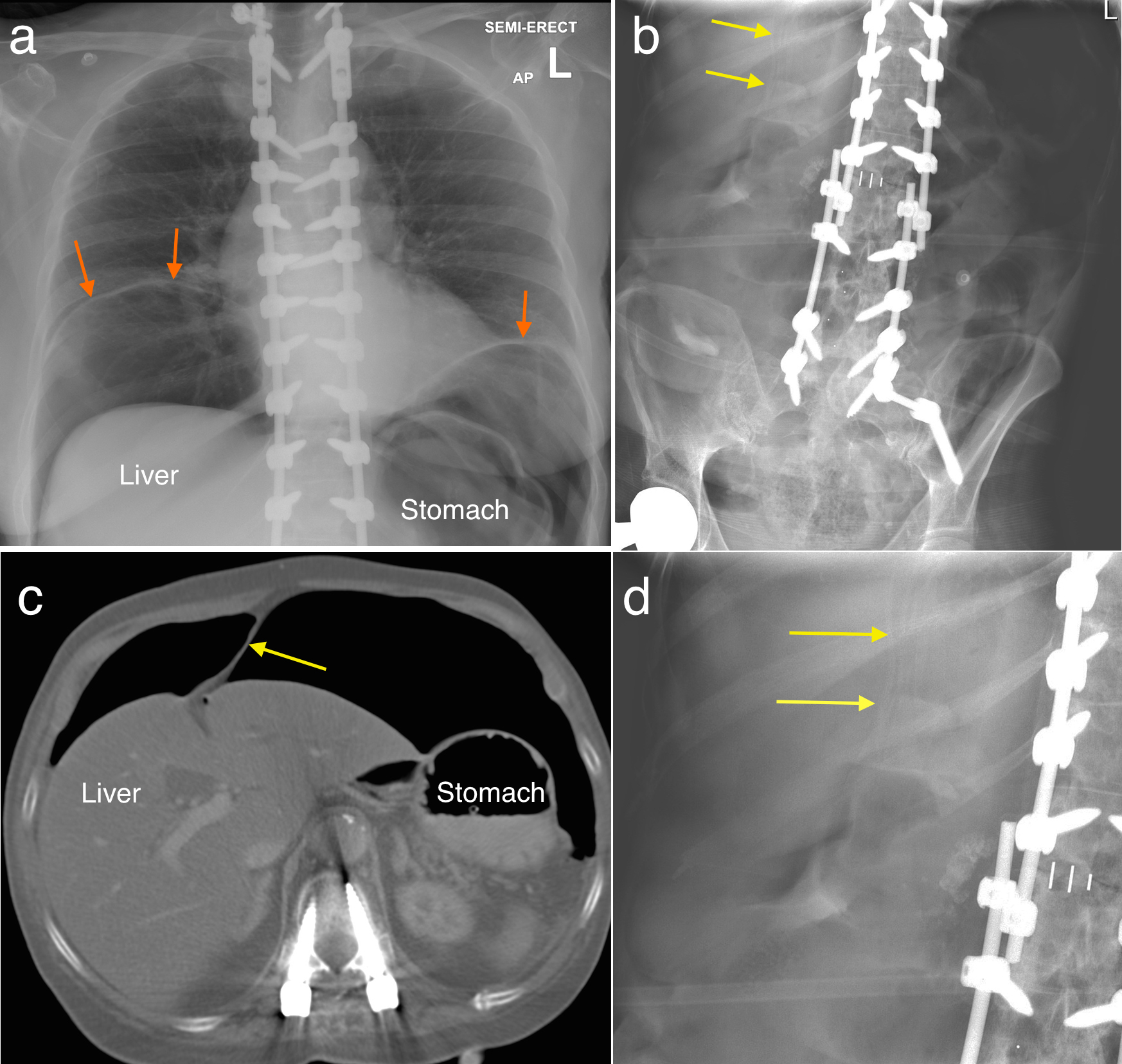 Falciform ligament sign Radiology at St. Vincent's University Hospital