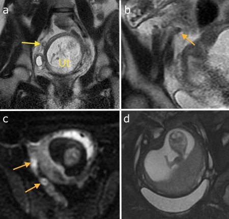 Appendicitis during pregnancy – MRI