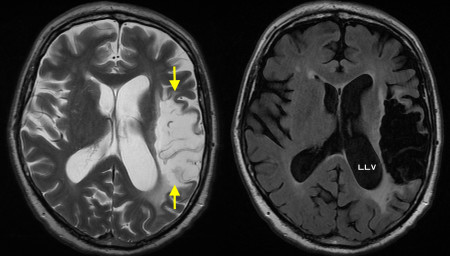 Encephalomalacia due to old MCA infarct