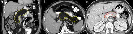 Pancreatic lipomatosis in cystic fibrosis – CT