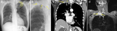 Pancoast tumour – CT/MRI