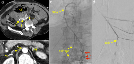 Embolization of superior mesenteric artery haemorrhage