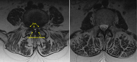 Lumbar spinal stenosis