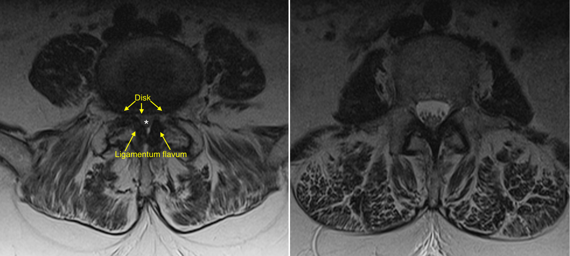 Lumbar spinal stenosis - Radiology at St. Vincent's University Hospital
