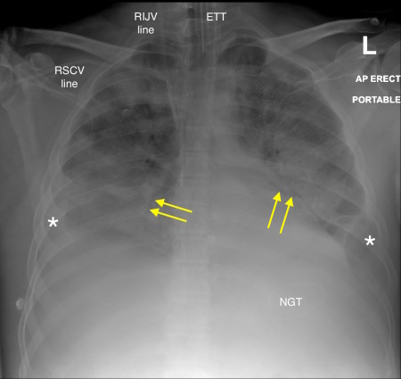 Acute respiratory distress syndrome (ARDS) – chest x-ray