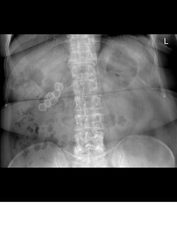 Gallstones on PFA