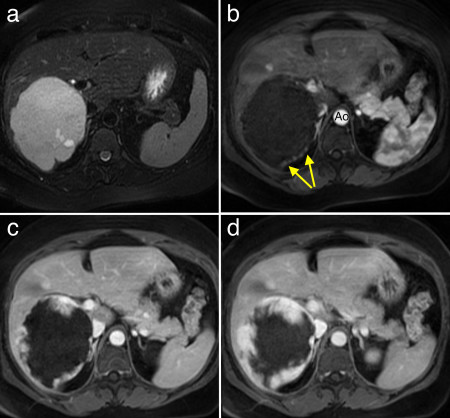 Haemangioma of liver – MRI