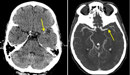Occluded middle cerebral artery on CT angiography