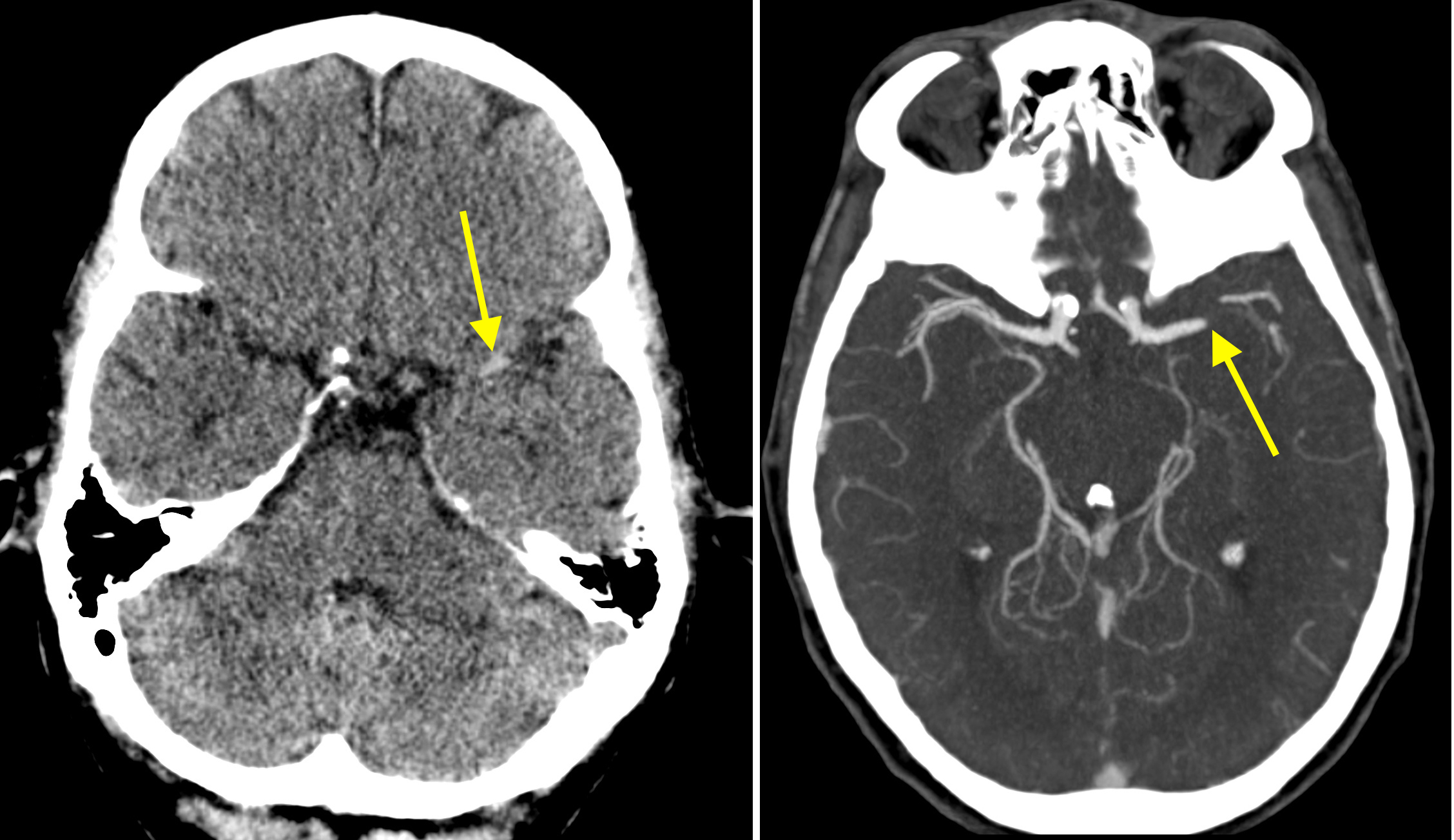 Occluded middle cerebral artery on CT angiography - Radiology at St