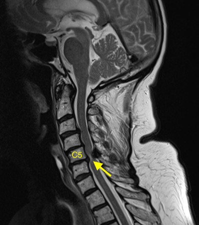 Cervical myelopathy – MRI