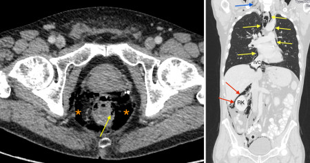 Rectal perforation with pneumomediastinum