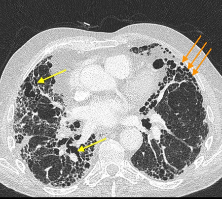 Honeycombing and traction bronchiectasis