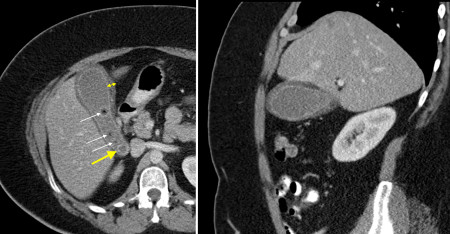 Acute cholecystitis on CT