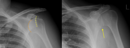 Shoulder dislocation with Bankart fracture
