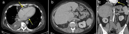 Constrictive pericarditis with cardiac cirrhosis