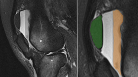 Liposerohaemarthrosis