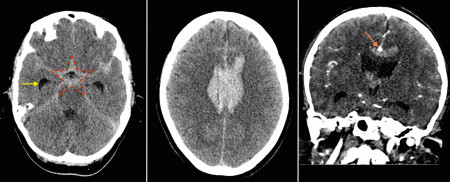 Ruptured pericallosal aneurysm with subarachnoid haemorrhage – CT