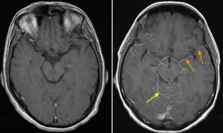 Leptomeningeal metastatic disease