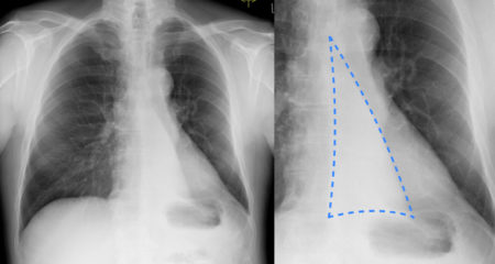 Left lower lobe collapse – CXR