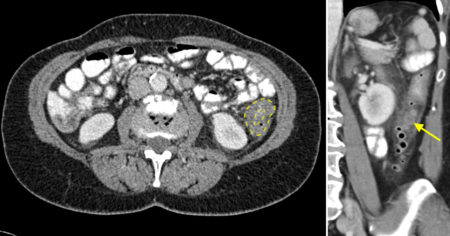 Acute diverticulitis – CT