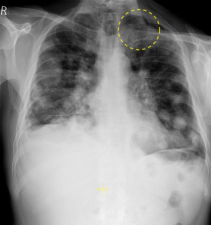 Lung metastases from head and neck cancer