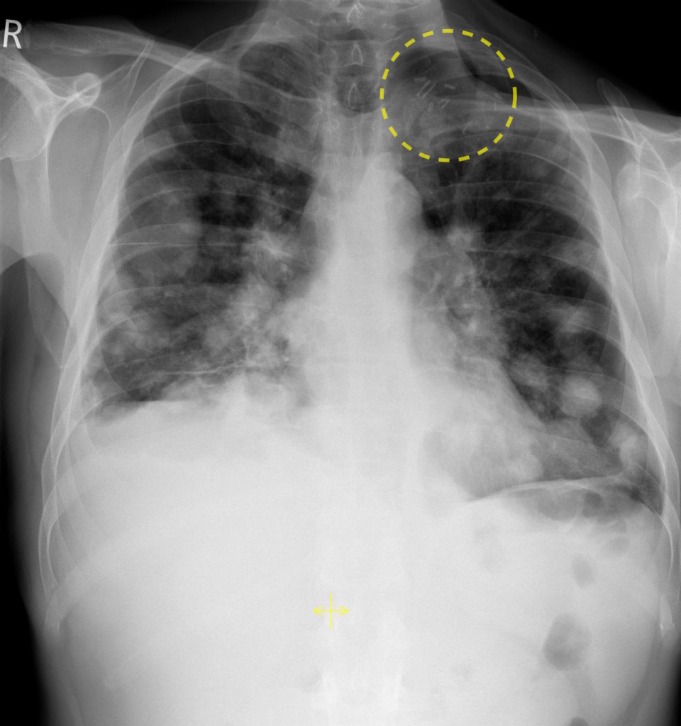 metastatic cancer in neck