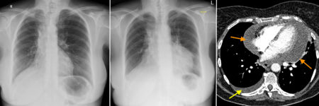 Pericardial effusion – CXR and CT