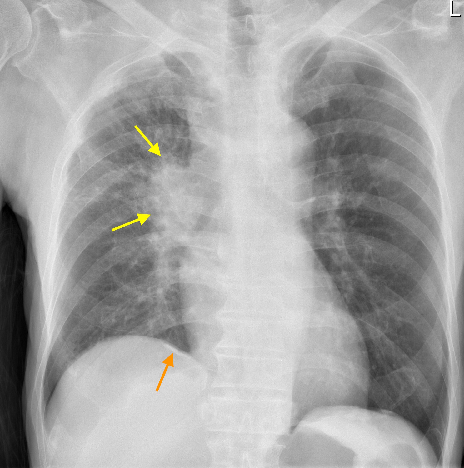 Lung cancer in patient with previous asbestos exposure - Radiology at