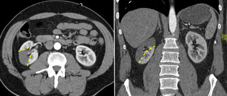 Renal infarct secondary to atrial fibrillation