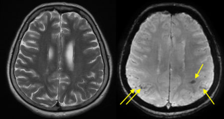 Cerebral Amyloid Angiopathy – MRI