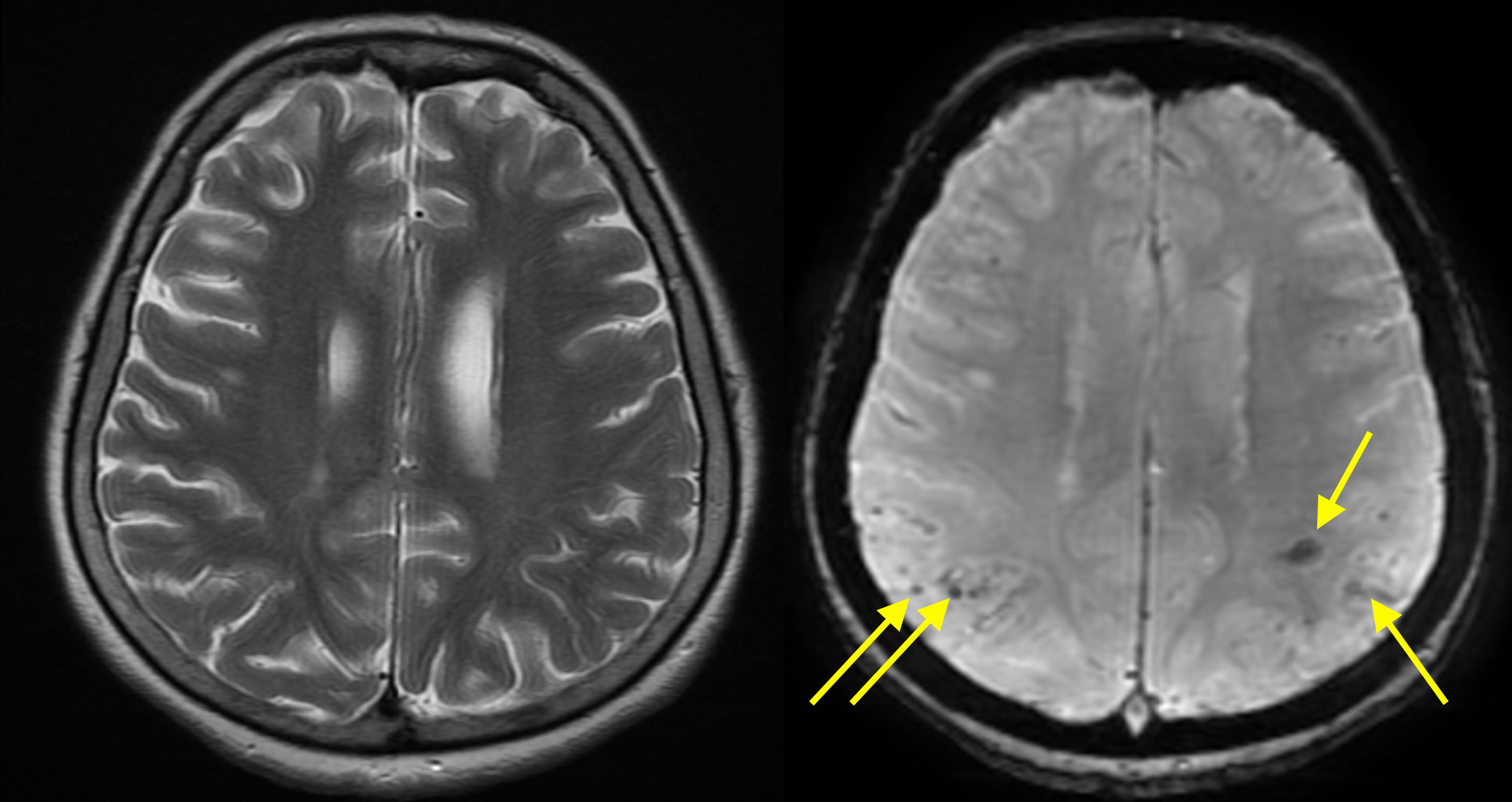 Cerebral Amyloid Angiopathy - MRI - Radiology at St. Vincent's