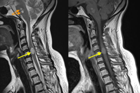 Spinal cord metastasis – MRI