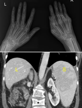 Felty syndrome