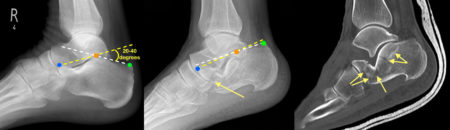 Calcaneal Fracture