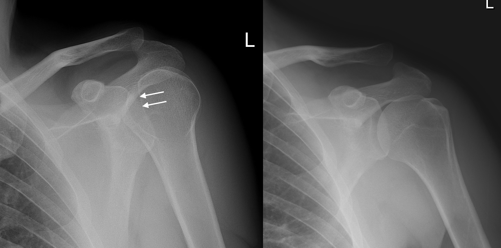 Posterior shoulder dislocation - Radiology at St. Vincent's University