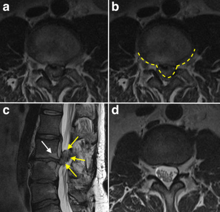 Cauda Equina Compression – MRI