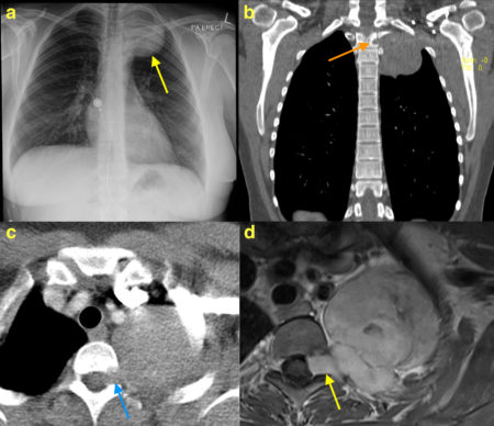 Chest wall schwannoma – CXR, CT and MRI